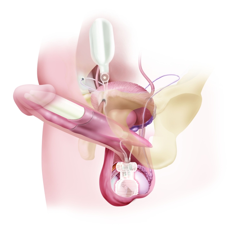 Penilní implantát Oficiální zdroj: ISCARE
